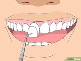 How to correct an underbite without surgery? 3 Ways To Fix An Underbite Wikihow