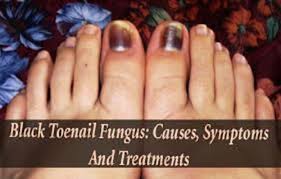 causes of black toenail fungus longevity