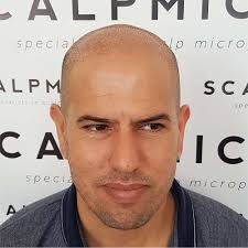 scalp micropigmentation clinic