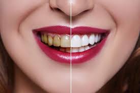 Your teeth will only get a few shades lighter with tooth whitening pens because the solution does not stay in contact with your. How Much Does Teeth Whitening Cost Revitalise Dental Centre