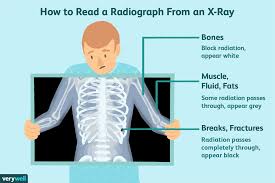 Check spelling or type a new query. Chest X Rays And Breast Cancer Uses Procedure Results