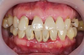what is chronic periodontal disease