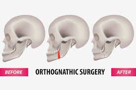 orthognathic surgery gany