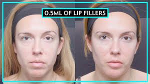 0 5ml of lip fillers