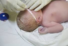 caput succedaneum when baby s conehead