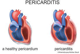 The pain is typically less severe when sitting up and more severe when lying down or breathing deeply. Pericarditis Tied To Mortality Morbidity Risks Physician S Weekly