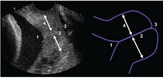 imaging of the uterine cervix
