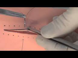 vertical mattress suture