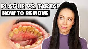 remove plaque from teeth