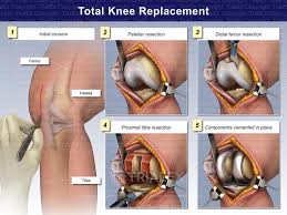 total knee replacement trial exhibits