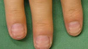 nail abnormalities symptoms causes