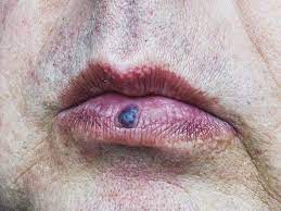 spot on lip causes symptoms and