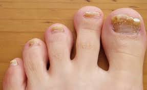 common toenail conditions podiatry