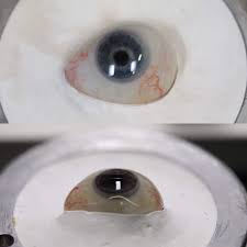 prosthetic eye need to be replaced