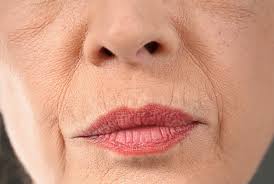 lip lines lazaderm free consultation