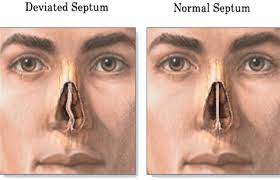 Surgery is the only way to fix a deviated septum. What Is A Deviated Septum Know More About Its Surgery And Recovery