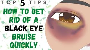 13 home remes for black eye causes