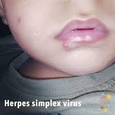 herpes simplex virus skin deep