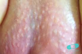 sebaceous glands fordyce spots or