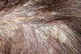 seborrheic dermais and hair loss