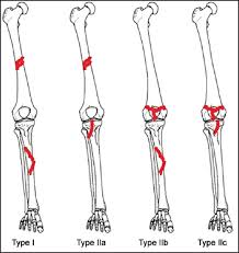 The winquist and hansen classification is a system of categorizing femoral shaft fractures based upon the degree of comminution.1. The Intramedullary Nailing Using A Single Knee Incision For Treatment Of Extraarticular Floating Knee Nine Cases Dahmani O Elrhazi A Elidrissi M Shimi M Elibrahimi A Elmrini A J Emerg Trauma