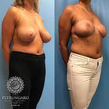 36 F Before and After Breast Lift | Petrungaro Plastic Surgery
