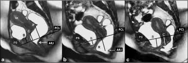 magnetic resonance imaging of pelvic