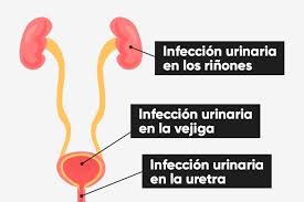 6 síntomas de infección urinaria con