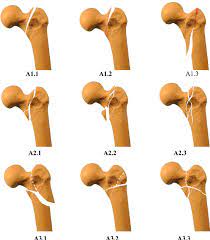 proximal fem fractures causes