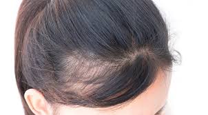 If traction alopecia continues, a person may develop bald spots and thinning of the hair. Women And Bald Spots What To Do Blog Keranique