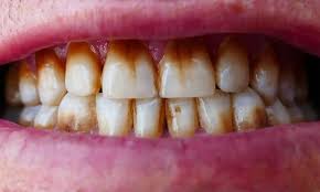 Your teeth can help prevent the staining from getting too bad. How To Remove Brown Stains From Teeth Express Co Uk