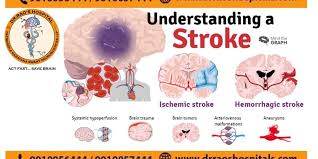 the best stroke treatment in guntur iv