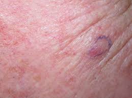 acd a z of skin merkel cell carcinoma