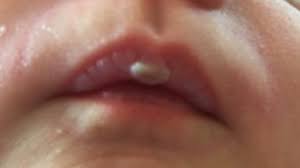 pediatric pearls infant s mouth part 1