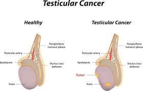 testicular cancer symptoms cause