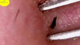 But of all the satisfying blackhead removal videos we've seen, this one might take the cake for the fastest and most efficient. Ingrown Hair Removal Blackhead Pimple Popping Most Satisfying Videos In The World 9 Hd 2018 Pimple Popping Videos