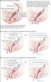 surgical repair of pelvic