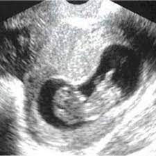 Im ultraschall ist inzwischen ein richtiger kleiner mensch zu sehen. á… 10 Ssw Schwangerschaftswoche Alle Infos Grosse Entwicklung