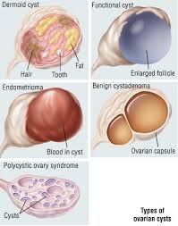cysts guide causes symptoms and