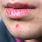 how to get rid of pimple on lip