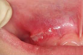 canker sores aphthous ulcer causes