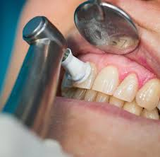 Da zahnstein zu weiteren erkrankungen im mundraum führen kann, ist es notwendig, den festen belag regelmäßig zu beseitigen. Was Professionelle Zahnreinigung Wirklich Bringt Welt