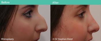 Check spelling or type a new query. 6 Common Nose Shape Concerns Rhinoplasty Can Help