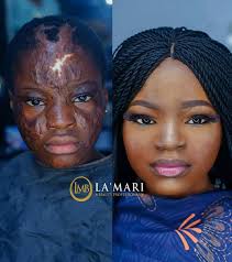disfigured after fire accident photos
