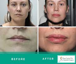 lip plastic surgery before afters