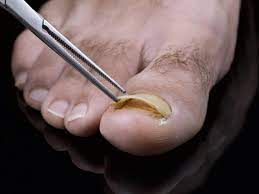 how to soften thick toenails toenail