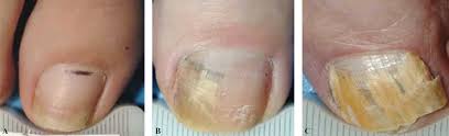 brief treatment guide for onychomycosis