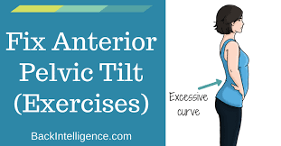 how to fix anterior pelvic tilt posture