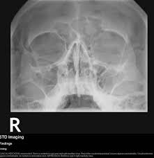 retention cyst in maxillary sinus