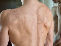 cystic back acne causes and how to